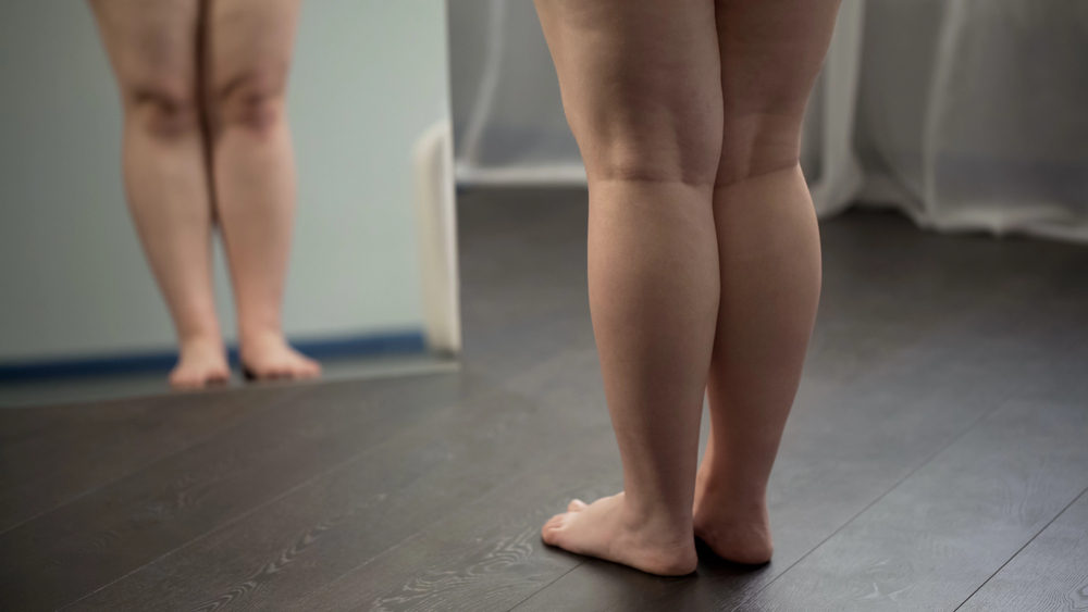 Is Body Dysmorphia an Eating Disorder? Here’s What You Need to Know 3